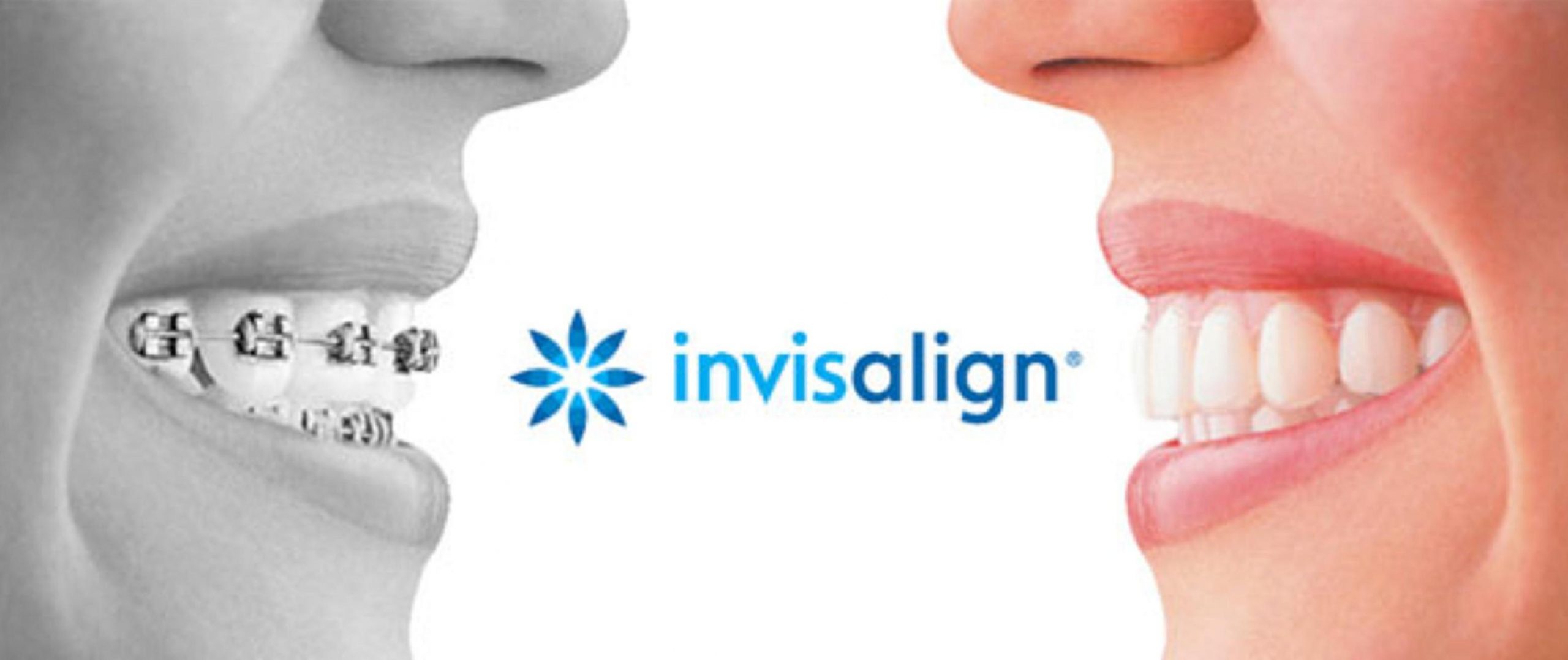 Invisalign